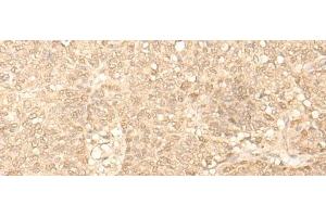 Immunohistochemistry of paraffin-embedded Human ovarian cancer tissue using FAH Polyclonal Antibody at dilution of 1:40(x200)