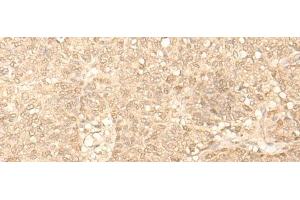 Immunohistochemistry of paraffin-embedded Human ovarian cancer tissue using FAH Polyclonal Antibody at dilution of 1:40(x200) (FAH anticorps)