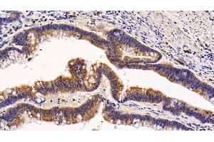 Detection of KRT6A in Human Colorectal cancer Tissue using Polyclonal Antibody to Keratin 6A (KRT6A)