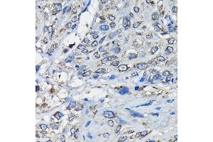 Immunohistochemistry of paraffin-embedded human esophageal cancer using RanG Rabbit pAb (ABIN6128613, ABIN6146681, ABIN6146683 and ABIN6217306) at dilution of 1:50 (40x lens). (RANGAP1 anticorps  (AA 398-587))