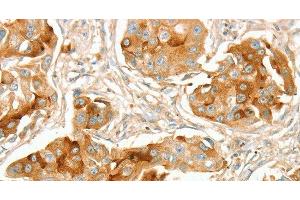 Immunohistochemistry of paraffin-embedded Human breast cancer using ACE1 Polyclonal Antibody at dilution of 1:70 (Angiotensin I Converting Enzyme 1 anticorps)