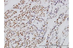 Immunoperoxidase of monoclonal antibody to SYMPK on formalin-fixed paraffin-embedded human ovary, clear cell carcinoma. (Symplekin anticorps  (AA 1-533))