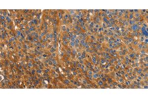 Immunohistochemistry of paraffin-embedded Human liver cancer using ORM2 Polyclonal Antibody at dilution of 1:40 (Orosomucoid 2 anticorps)