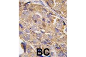 Formalin-fixed and paraffin-embedded human breast carcinoma tissue reacted with EIF4B-, which was peroxidase-conjugated to the secondary antibody, followed by DAB staining.
