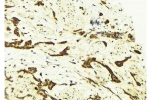 ABIN6269249 at 1/100 staining Human breast cancer tissue by IHC-P. (STAT5A anticorps)