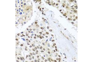 Immunohistochemistry of paraffin-embedded human lung cancer using BNIP3L antibody. (BNIP3L/NIX anticorps)