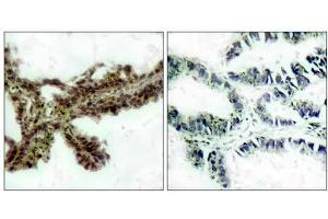 Immunohistochemical analysis of paraffin-embedded human lung carcinoma tissue, using Akt (phospho-Thr308) antibody(E011055). (AKT1 anticorps  (pThr308))