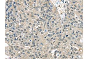 The image on the left is immunohistochemistry of paraffin-embedded Human breast cancer tissue using ABIN7128053(TXNDC17 Antibody) at dilution 1/30, on the right is treated with fusion protein. (TXNDC17 anticorps)