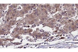 ABIN6273958 at 1/100 staining Human liver cancer tissue by IHC-P. (OR51L1 anticorps  (Internal Region))