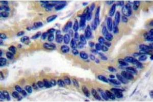 Immunohistochemistry analyzes of Actived-Caspase-3 p17 Antibody in paraffin-embedded human lung carcinoma tissue. (Caspase 3 anticorps)
