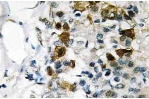 Immunohistochemistry (IHC) analyzes of p-HSP27 antibody in paraffin-embedded human breast carcinoma tissue. (HSP27 anticorps  (pSer82))