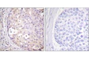 Immunohistochemistry analysis of paraffin-embedded human breast carcinoma tissue, using PKC-pan (Ab-Thr497) Antibody. (PKC anticorps  (Thr497))