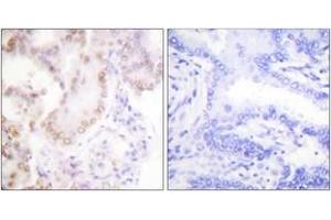 Immunohistochemistry analysis of paraffin-embedded human lung carcinoma tissue, using Cyclin G Antibody. (Cyclin G1 anticorps  (AA 161-210))