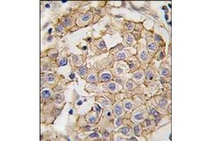 Formalin-fixed and paraffin-embedded human breast carcinoma tissue reacted with HER2 antibody, which was peroxidase-conjugated to the secondary antibody, followed by DAB staining. (ErbB2/Her2 anticorps)