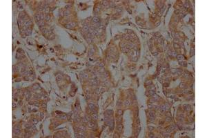 IHC image of ABIN7127784 diluted at 1:100 and staining in paraffin-embedded human breast cancer performed on a Leica BondTM system.