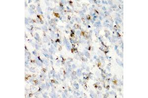 Immunohistochemistry of paraffin-embedded human esophageal cancer using CD68 antibody at dilution of 1:200 (40x lens). (CD68 anticorps)