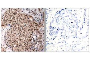 Immunohistochemical analysis of paraffin-embedded human breast carcinoma tissue, using MAPKAPK-2 (Phospho-Thr334) antibody (E011308). (MAPKAP Kinase 2 anticorps  (pThr334))