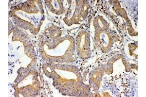 IHC testing of FFPE human rectal cancer tissue with TSPAN12 antibody at 1ug/ml. (TSPAN12 anticorps)