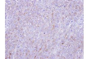 IHC-P Image Immunohistochemical analysis of paraffin-embedded DLD-1 xenograft, using Glypican-1, antibody at 1:100 dilution.