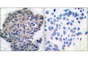 Immunohistochemistry analysis of paraffin-embedded human breast carcinoma, using Filamin A (Phospho-Ser2152) Antibody. (Filamin A anticorps  (pSer2152))