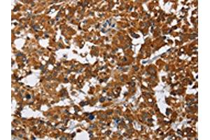 The image on the left is immunohistochemistry of paraffin-embedded Human thyroid cancer tissue using ABIN7128790(CAT Antibody) at dilution 1/40, on the right is treated with fusion protein. (Catalase anticorps)