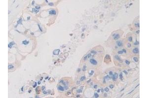 Detection of PDHX in Human Bile duct cancer Tissue using Polyclonal Antibody to Pyruvate Dehydrogenase Complex Component X (PDHX) (PDHX anticorps  (AA 220-468))