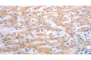 Immunohistochemistry of paraffin-embedded Human liver cancer using PAK1 Polyclonal Antibody at dilution of 1:40