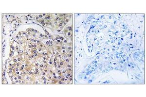 Immunohistochemistry analysis of paraffin-embedded human breast carcinoma tissue using GPR116 antibody. (G Protein-Coupled Receptor 116 anticorps  (C-Term))