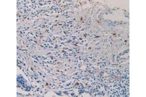 IHC-P analysis of Human Prostate Gland Cancer Tissue, with DAB staining. (TPSAB1 anticorps  (AA 161-262))