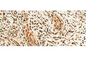 Immunohistochemistry of paraffin-embedded Human esophagus cancer tissue using PPM1G Polyclonal Antibody at dilution of 1:40(x200) (PPM1G anticorps)