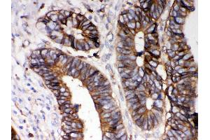 Anti- HLA-A Picoband antibody,IHC(P) IHC(P): Human Intestinal Cancer Tissue (HLA-A anticorps  (N-Term))