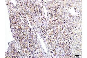 Formalin-fixed and paraffin embedded human cervical carcinoma labeled with Anti APE/Girdin Polyclonal Antibody, Unconjugated (ABIN755587) at 1:200 followed by conjugation to the secondary antibody and DAB staining (Girdin anticorps  (AA 1401-1500))