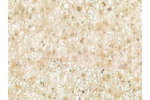 ABIN6262119 and ABIN6273252 at 1/100 staining human astrocytoma by IHC-P.