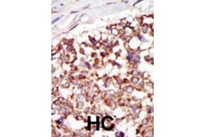 Formalin-fixed and paraffin-embedded human hepatocellular carcinoma tissue reacted with the PAK4 polyclonal antibody  , which was peroxidase-conjugated to the secondary antibody, followed by DAB staining. (PAK4 anticorps  (N-Term))