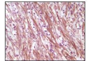 Immunohistochemical analysis of paraffin-embedded human smooth musde sarcoma, showing cytoplasmic localization using Desmin mouse mAb with DAB staining. (Desmin anticorps)