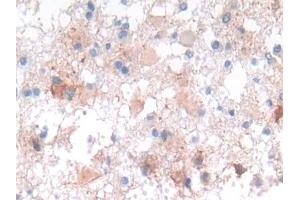 Detection of NCAD in Human Glioma Tissue using Polyclonal Antibody to N-cadherin (NCAD) (N-Cadherin anticorps  (AA 685-784))