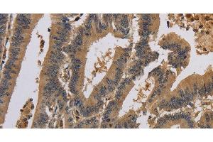 Immunohistochemistry of paraffin-embedded Human colon cancer using KCNA7 Polyclonal Antibody at dilution of 1:40