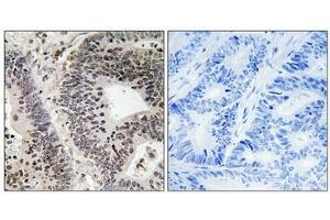 Immunohistochemical analysis of paraffin-embedded human colon carcinoma tissue using WWOX (Phospho-Tyr33) antibody (left)or the same antibody preincubated with blocking peptide (right). (WWOX anticorps  (pTyr33))