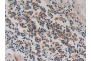 DAB staining on IHC-P; Samples: Human Stomach cancer Tissue (PKIG anticorps  (AA 1-76))