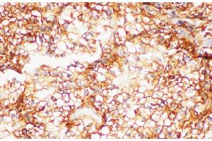 Immunohistochemistry of paraffin-embedded Human kidney cancer using FOLH1 Polycloanl Antibody at dilution of 1:200 (PSMA anticorps)