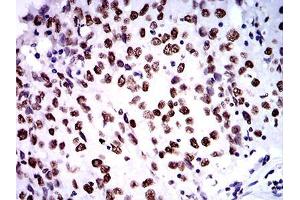 Immunohistochemical analysis of paraffin-embedded ovarian cancer tissues using ZFP91 mouse mAb with DAB staining.