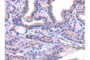 The image on the left is immunohistochemistry of paraffin-embedded Human thyroid cancer tissue using ABIN7131472(TRIM14 Antibody) at dilution 1/40, on the right is treated with fusion protein. (TRIM14 anticorps)