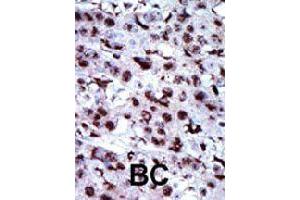 Formalin-fixed and paraffin-embedded human cancer tissue reacted with AK5 polyclonal antibody  , which was peroxidase-conjugated to the secondary antibody, followed by AEC staining.
