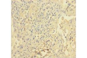 Immunohistochemistry of paraffin-embedded human lung cancer using ABIN7175384 at dilution of 1:100 (VEGFR2/CD309 anticorps  (AA 20-764))