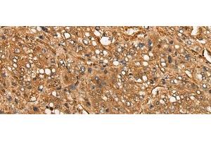 Immunohistochemistry of paraffin-embedded Human liver cancer tissue using CALML6 Polyclonal Antibody at dilution of 1:55(x200) (CALML6 anticorps)