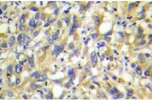 Immunohistochemistry  (IHC) analyzes of MKP-4 antibody in paraffin-embedded human liver carcinoma tissue.