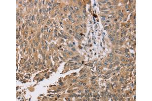 Immunohistochemistry of Human esophagus cancer using PDLIM7 Polyclonal Antibody at dilution of 1:35 (PDLIM7 anticorps)