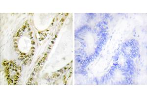 Immunohistochemistry analysis of paraffin-embedded human colon carcinoma tissue using IRF-3 (Phospho-Ser385) antibody.