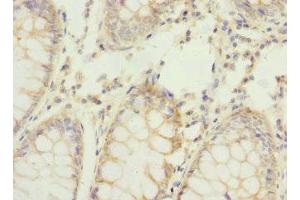 Immunohistochemistry of paraffin-embedded human colon cancer using ABIN7159199 at dilution of 1:100 (REC8 anticorps  (AA 1-270))