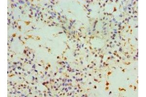 Immunohistochemistry of paraffin-embedded human breast cancer using ABIN7143947 at dilution of 1:100 (SNCA anticorps  (AA 61-140))